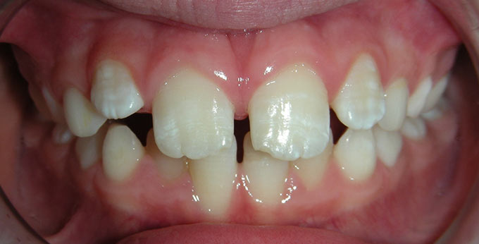 After treatment for traumatic deep bite with a plate (upper removable appliance)